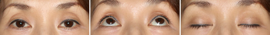 Eyelid Ptosis, Case1, Before The Operation