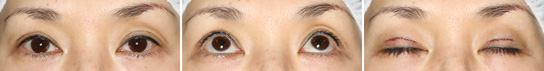 眼瞼下垂症/症例１/手術直後