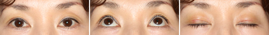 Eyelid Ptosis, Case1, Forth Day After The Operation
