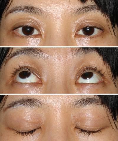 原元クリニック 眼瞼下垂症 鼻の形成の専門的治療