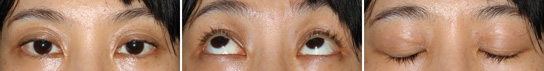 Eyelid Ptosis, Case2, Before The Operation