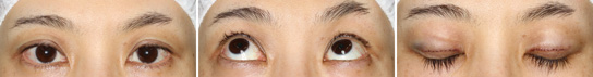 Eyelid Ptosis, Case2, Immediately After The Operation