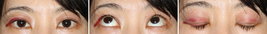 Eyelid Ptosis, Case2, Second Day After The Operation