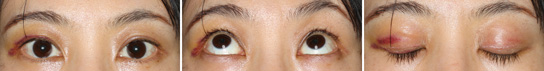 Eyelid Ptosis, Case2, Fifth Day After The Operation
