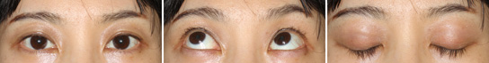 眼瞼下垂症/症例２/手術後１か月目