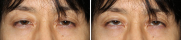 Ptosis/Case1/Preoperative primary-gaze view