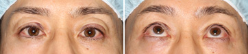 Ptosis/Case1/Immediate Postoperative primary-gaze view