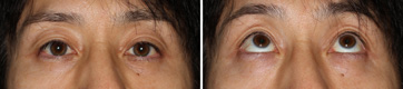 眼瞼下垂症/症例1/術後3カ月正面視
