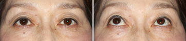 Ptosis/Case5/3 month Postoperative primary-gaze view