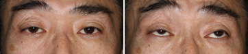 Ptosis/Case6/Preoperative primary-gaze view