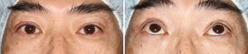 Ptosis/Case6/Immediate Postoperative primary-gaze view