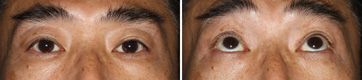 Ptosis/Case6/3 month Postoperative primary-gaze view