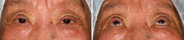 Ptosis/Case3/Immediate Postoperative primary-gaze view