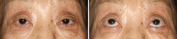 Ptosis/Case3/3 month Postoperative primary-gaze view