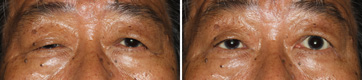 Ptosis/Case4/Post-fascia-transplantation primary-gaze view