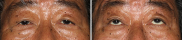 Ptosis/Case4/Postoperative final primary-gaze view